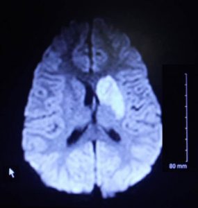 Scan of childhood stroke damage
